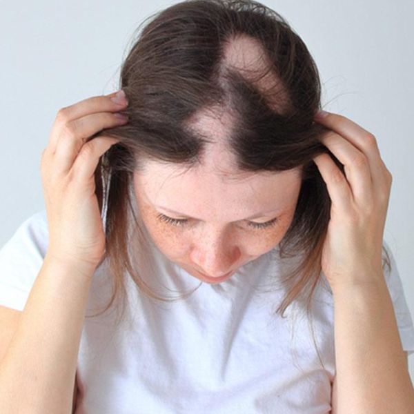 Patchy Hair Loss Treatment